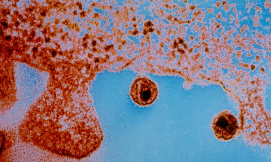 अमेरिकामा पहिलो पटक ‘स्टेम सेल’ थेरापीबाट एचआईभी संक्रमित महिलाको सफल उपचार