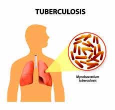 आठ महिनामा ९ सय ९२ क्षयरोगी, २८ जनाको मृत्यु